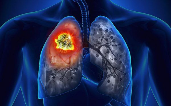 phòng ngừa ung thư phổi